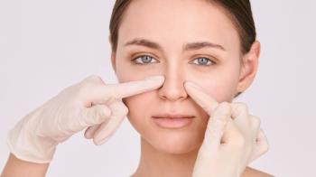  Rinoplasti sonrası şişlik nasıl geçer?